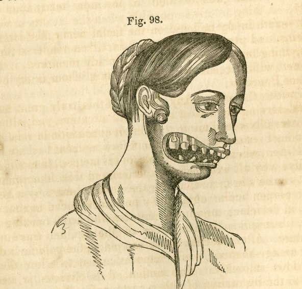 Illustration of phossy jaw disease from a book showing a woman with a disformed jaw as a result of working with white phosphorus (also known as yellow phosphorus) without proper safeguards.